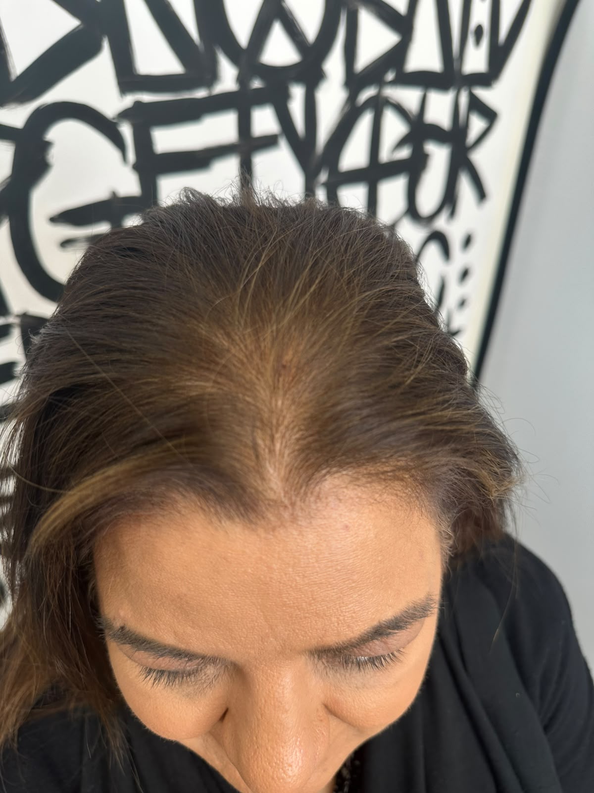 Women's SMP Boston before treatment