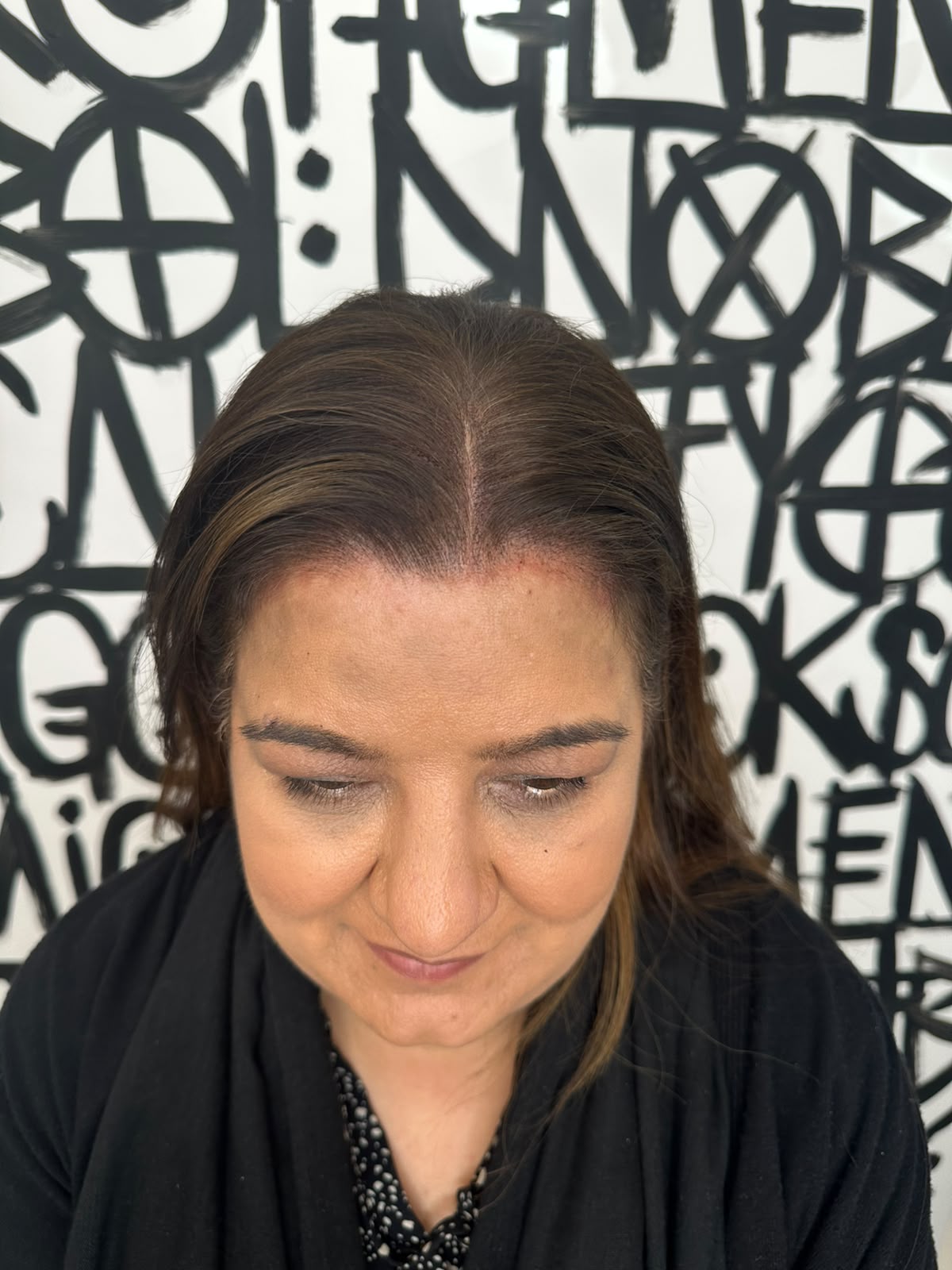 Women's SMP Boston after, healed result